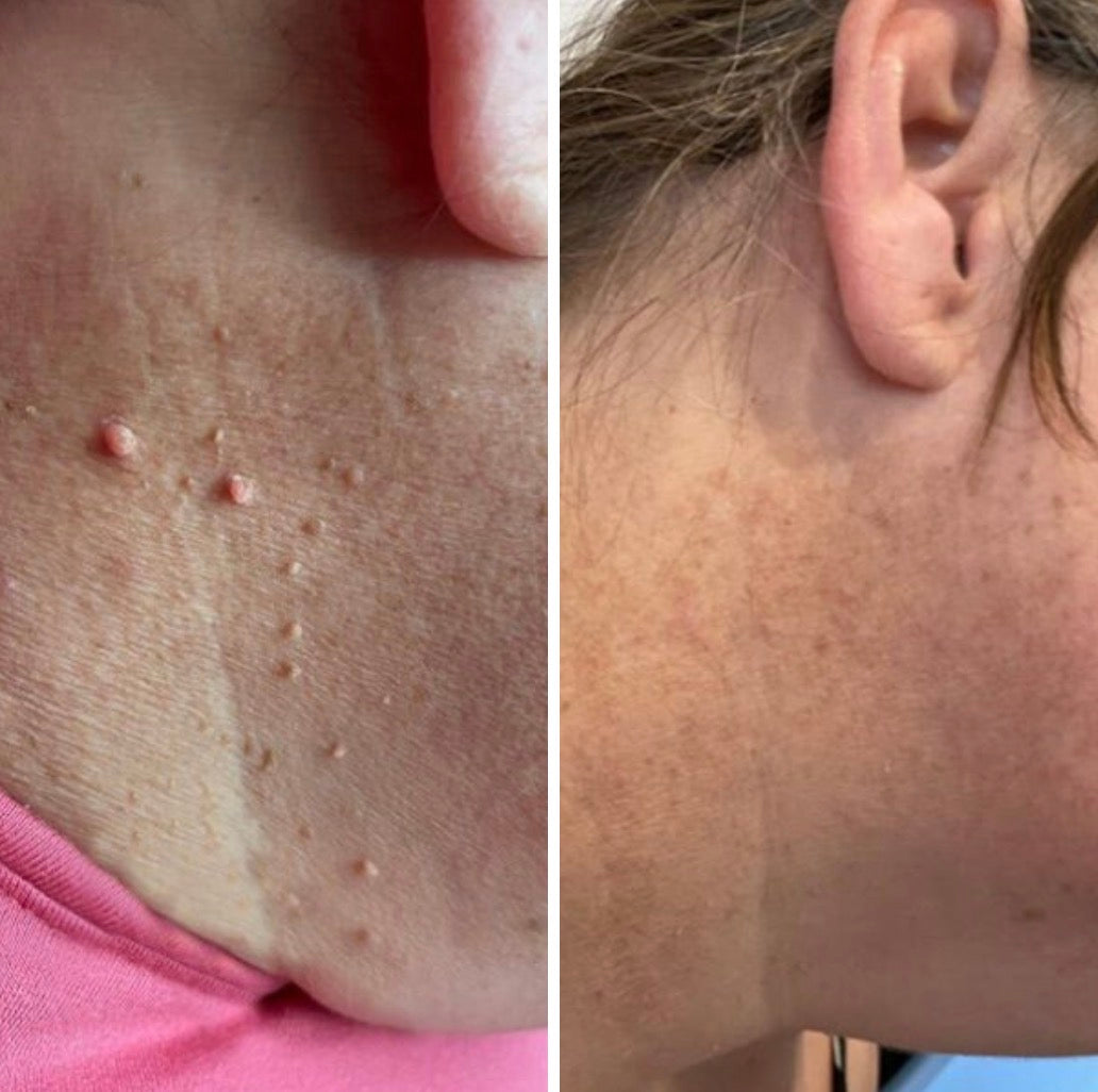 DermoClear™ – Addio ai Fibromi Penduli!